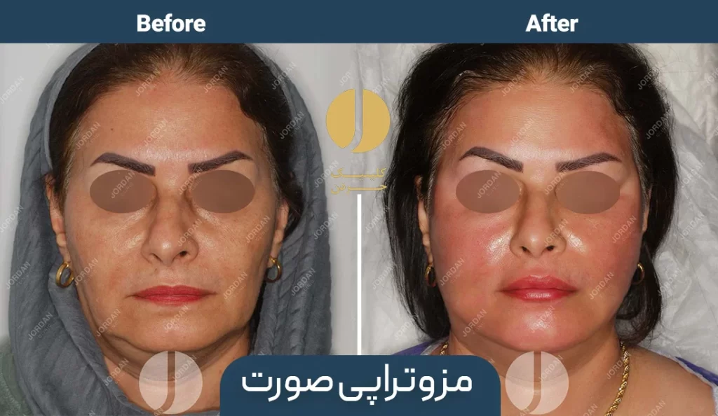 تصویر قبل و بعد مزوتراپی صورت