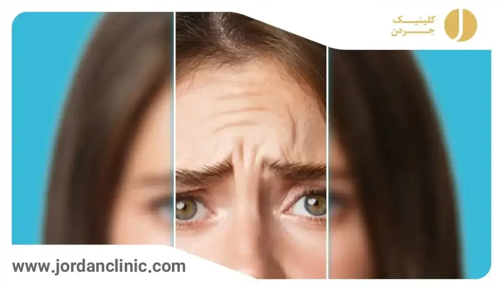 عکس ژل خط اخم