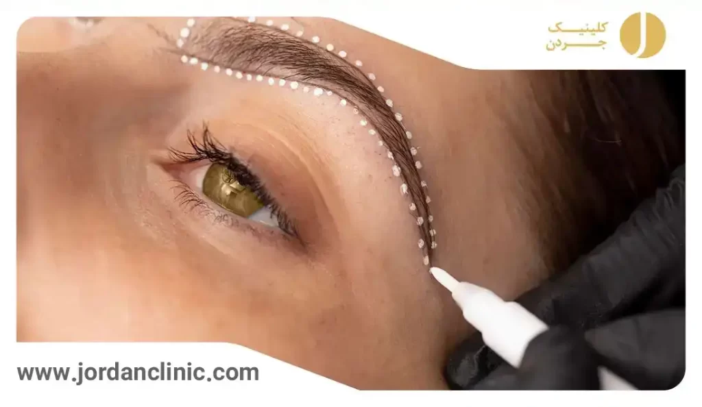 کاشت موی ابرو