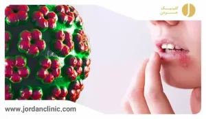 رفع تبخال فوری/علت تبخال لب چیست