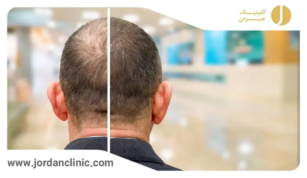کاشت مو کلینیک جردن