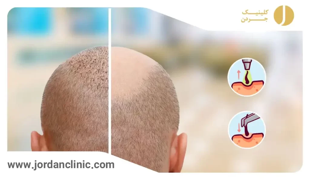 عکس قبل و بعد کاشت مو