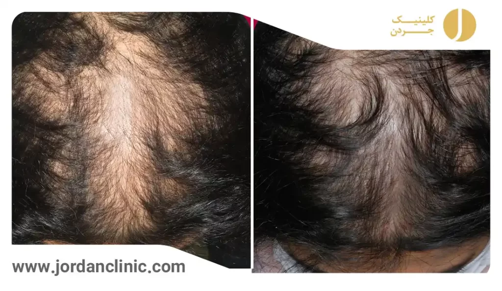 نمونه کار مزوتراپی مو در کلینیک مزوتراپی خوب