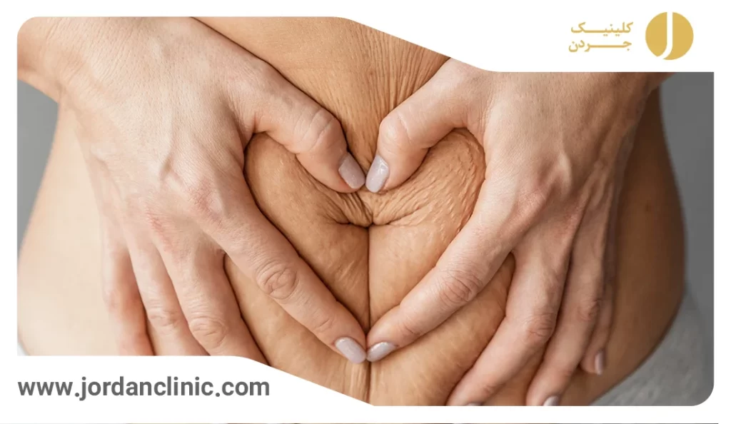 کاهش چربی شکم با اندولیفت