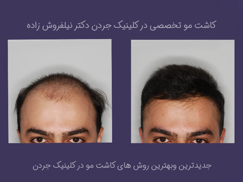 کاشت مو